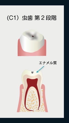 虫歯第2段階