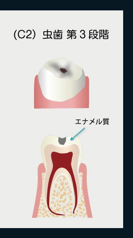 虫歯第2段階
