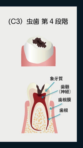 (C3)虫歯第4段階