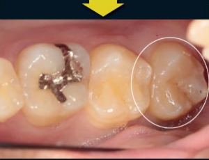 歯牙移植3