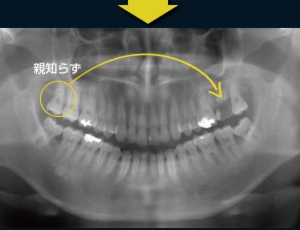 歯牙移植2