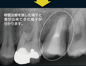 歯牙移植7