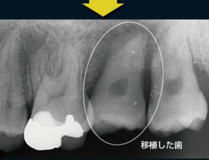 歯牙移植6