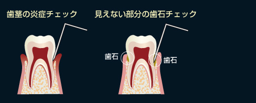 歯肉炎のチェック　/ 見えない部分の歯石チェック