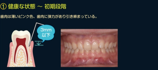歯周病　健康な状態〜初期段階