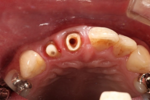 抜髄後の歯の様子