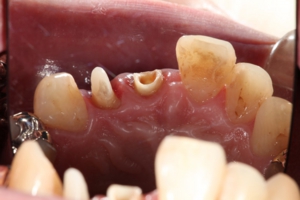 抜髄後の歯の様子