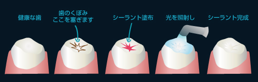 シーラントとは？虫歯になりやすい溝を塞いで虫歯を予防します。