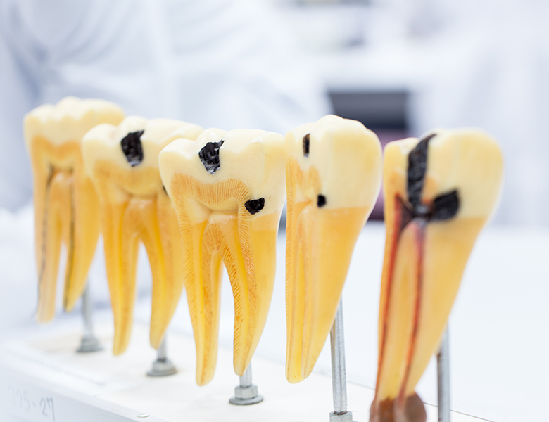 千葉県茂原市の歯医者、たけ歯科クリニックのむし歯治療