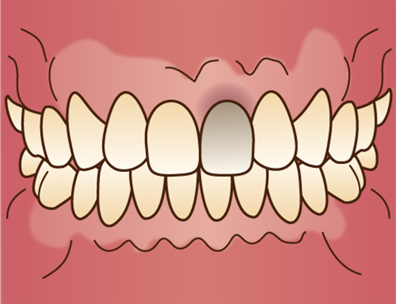 千葉県茂原市の歯医者、たけ歯科クリニックのホワイトニング