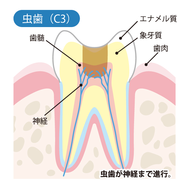 千葉県茂原市の歯医者、たけ歯科クリニックのむし歯治療