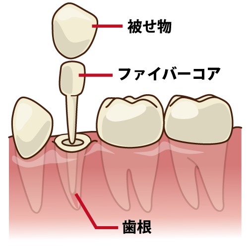 千葉県茂原市の歯医者、たけ歯科クリニックの根管治療
