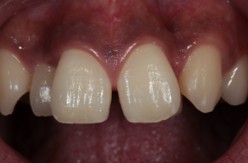 千葉県茂原市の歯医者、たけ歯科クリニックのダイレクトボンディング治療例