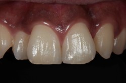 千葉県茂原市の歯医者、たけ歯科クリニックのダイレクトボンディング治療例