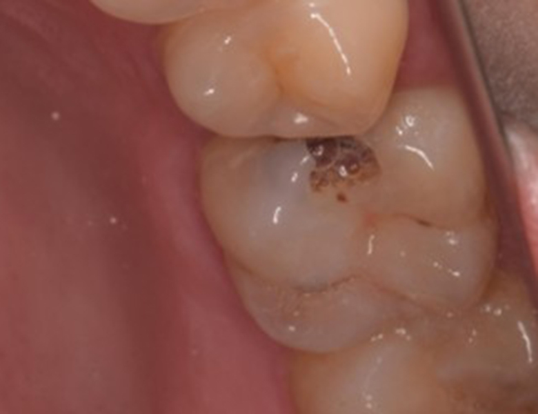 千葉県茂原市の歯医者、たけ歯科クリニックのMTA治療症例