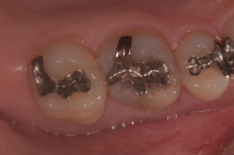 千葉県茂原市の歯医者、たけ歯科クリニックのダイレクトボンディング治療例