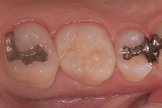 千葉県茂原市の歯医者、たけ歯科クリニックのダイレクトボンディング治療例