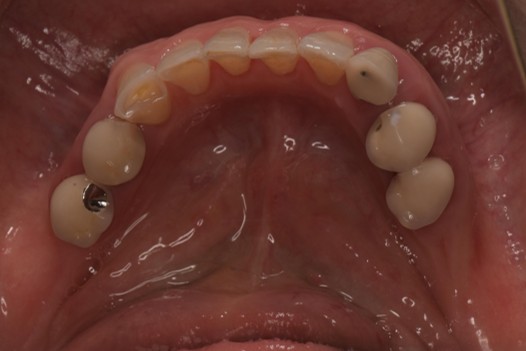 千葉県茂原市の歯医者、たけ歯科クリニックのダイレクトボンディング治療例