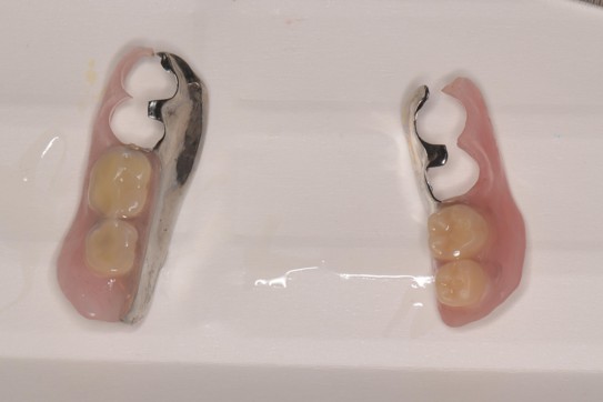 千葉県茂原市の歯医者、たけ歯科クリニックのダイレクトボンディング治療例