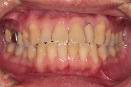 千葉県茂原市の歯医者、たけ歯科クリニックのダイレクトボンディング治療例