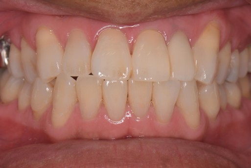 千葉県茂原市の歯医者、たけ歯科クリニックのダイレクトボンディング治療例