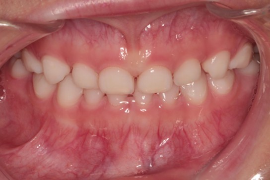 千葉県茂原市の歯医者、たけ歯科クリニックの小児矯正（プレオルソ）治療例