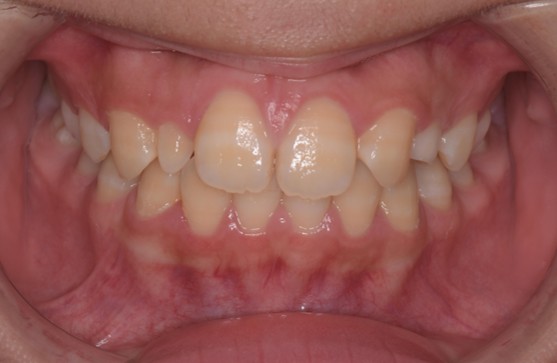 千葉県茂原市の歯医者、たけ歯科クリニックの小児矯正（プレオルソ）治療例