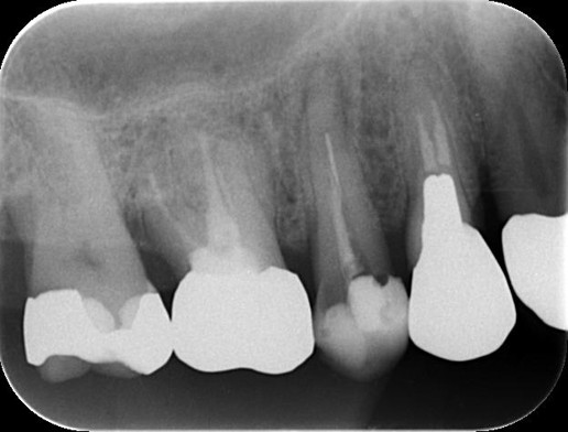 千葉県茂原市の歯医者、たけ歯科クリニックの破折ファイル除去症例