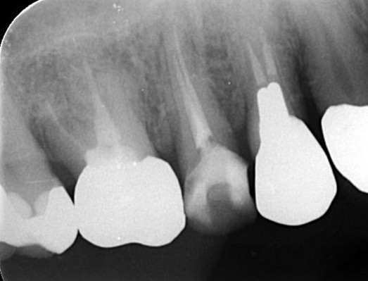 千葉県茂原市の歯医者、たけ歯科クリニックの破折ファイル除去症例