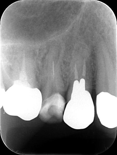 千葉県茂原市の歯医者、たけ歯科クリニックの破折ファイル除去症例