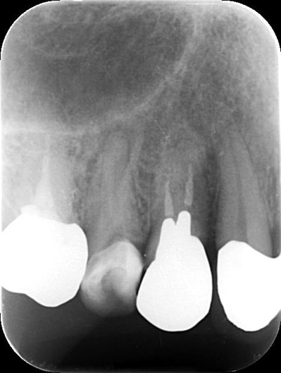千葉県茂原市の歯医者、たけ歯科クリニックの破折ファイル除去症例
