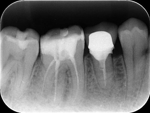 千葉県茂原市の歯医者、たけ歯科クリニックのエクストルージョン症例