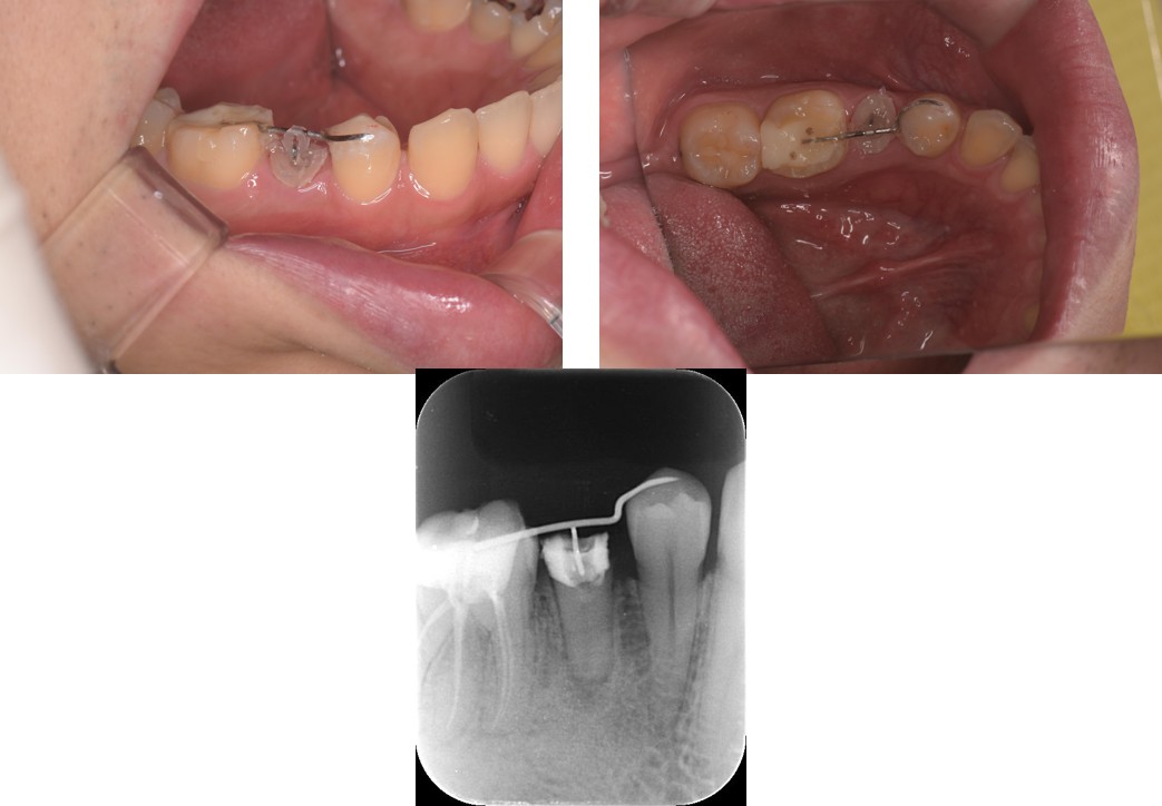 千葉県茂原市の歯医者、たけ歯科クリニックのエクストルージョン症例