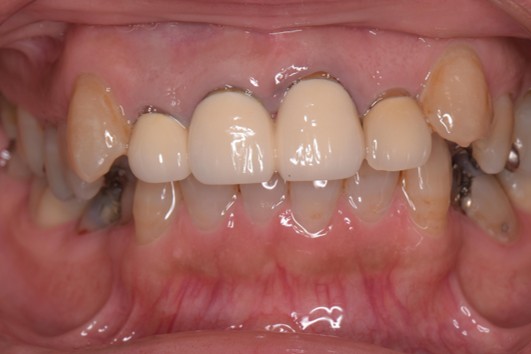 千葉県茂原市の歯医者、たけ歯科クリニックのエクストルージョン症例