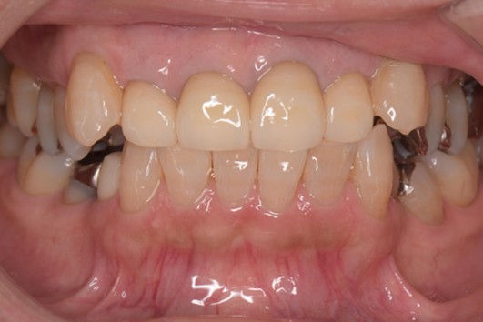 千葉県茂原市の歯医者、たけ歯科クリニックのエクストルージョン症例