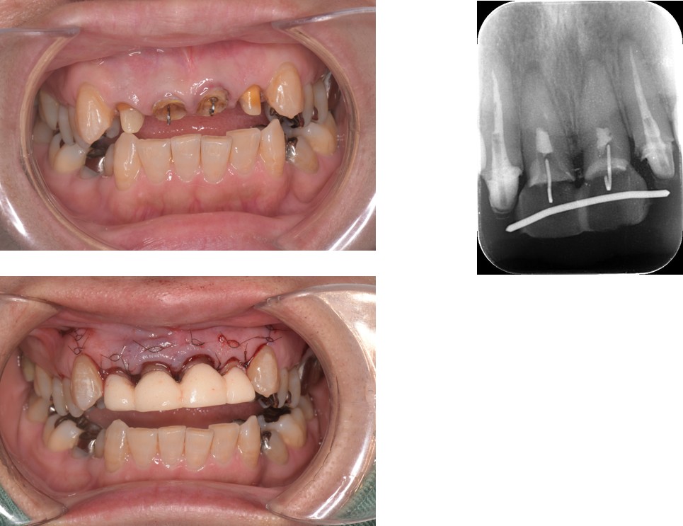 千葉県茂原市の歯医者、たけ歯科クリニックのエクストルージョン症例