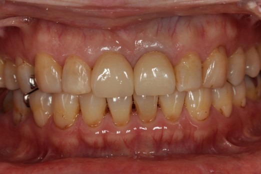 千葉県茂原市の歯医者、たけ歯科クリニックのジルコニアクラウン症例