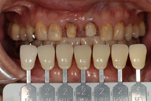 千葉県茂原市の歯医者、たけ歯科クリニックのジルコニアクラウン症例