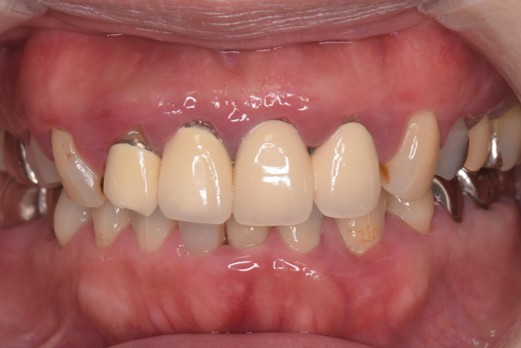 千葉県茂原市の歯医者、たけ歯科クリニックのエクストルージョン症例