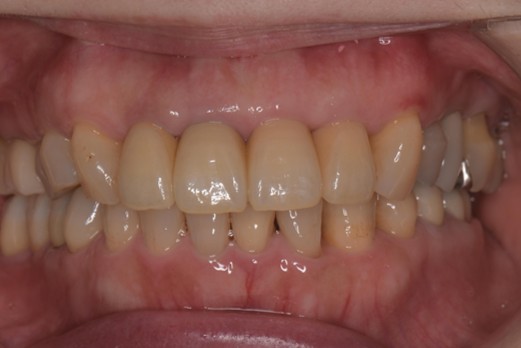 千葉県茂原市の歯医者、たけ歯科クリニックのエクストルージョン症例