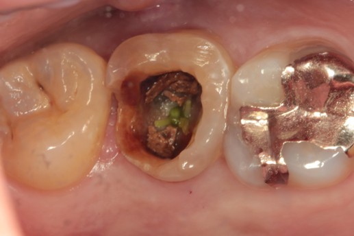 千葉県茂原市の歯医者、たけ歯科クリニックの破折ファイル除去症例