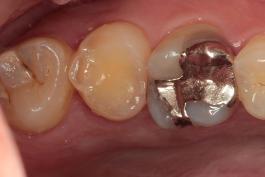 千葉県茂原市の歯医者、たけ歯科クリニックの破折ファイル除去症例