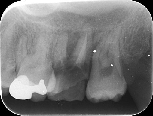 千葉県茂原市の歯医者、たけ歯科クリニックの破折ファイル除去症例