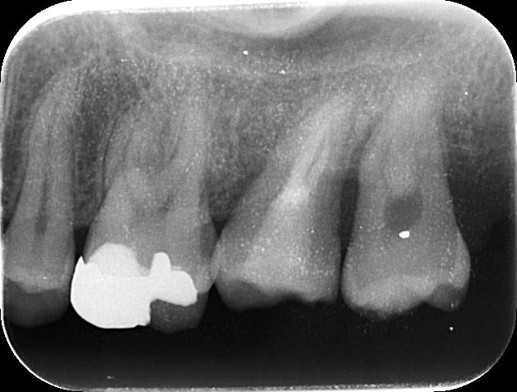 千葉県茂原市の歯医者、たけ歯科クリニックの破折ファイル除去症例